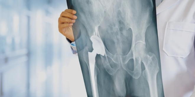 Hip replacement loosening treatment Chandigarh