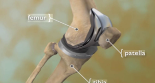 Best Total Knee Replacement Surgeon in Mumbai