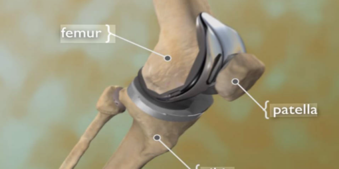 Best Total Knee Replacement Surgeon in Mumbai