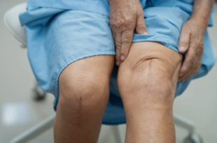 Knee Replacement Surgery Goa