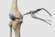 robotic knee replacement in Chandigarh