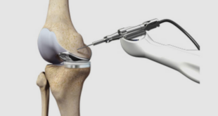 robotic knee replacement in Chandigarh