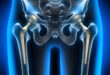 hip replacement hospitals in Chandigarh