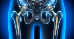 hip replacement hospitals in Chandigarh