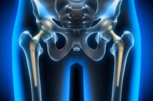hip replacement hospitals in Chandigarh