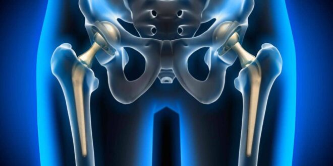 hip replacement hospitals in Chandigarh