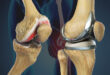 Best Knee Replacement Surgeon in Mumbai