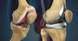 Best Knee Replacement Surgeon in Mumbai