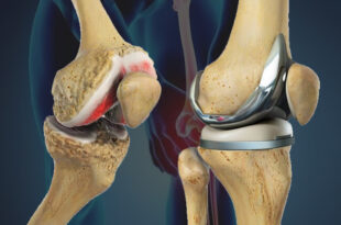 Best Knee Replacement Surgeon in Mumbai