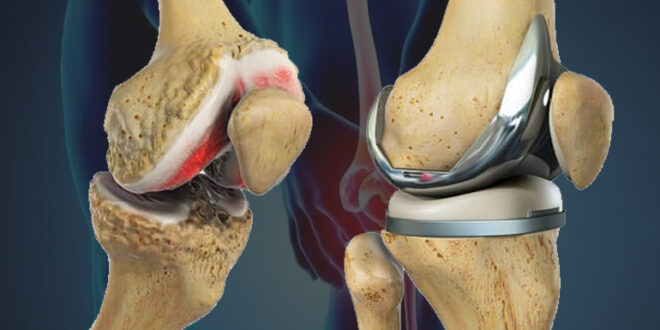 Best Knee Replacement Surgeon in Mumbai